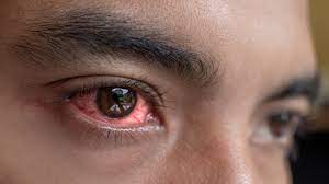 Health Alert | Conjunctivitis outbreak: 20 cases detected in a day in Mawlai Mawroh, most from NEHU
