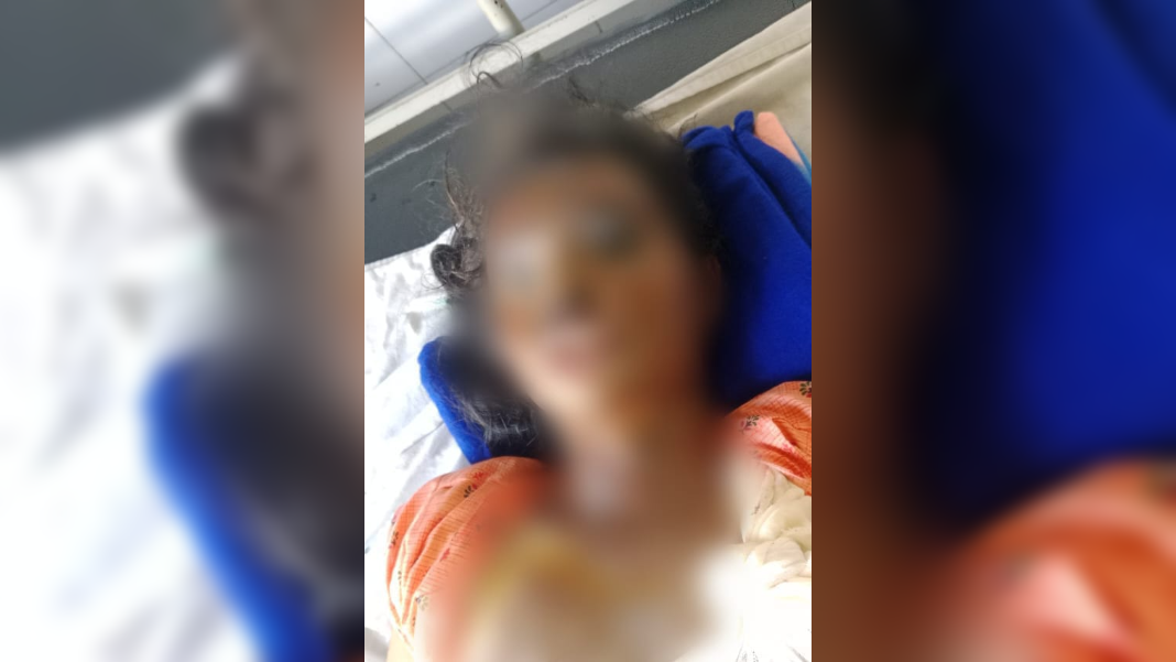 Assam: Jilted lover attacks minor with acid in Barpeta, held; FIR lodged