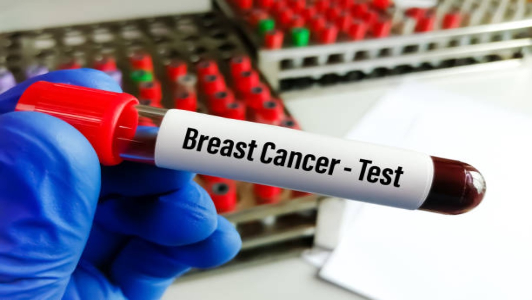 Breast cancer test. Representative photo.